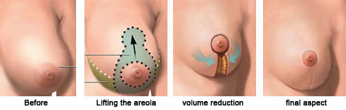 breast reduction tunisia